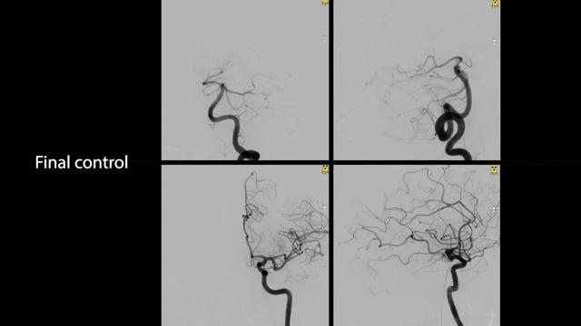 Ruptured Vermian AVM treated using Squid by venous approach